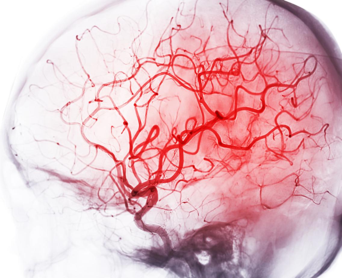 AVC : un risque accru de récidive chez certains patients en fibrillation atriale