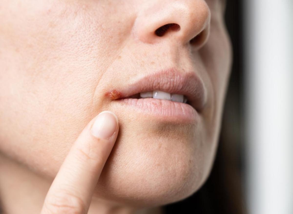 Herpès labial : 5 choses à ne surtout pas faire quand on a un bouton de fièvre