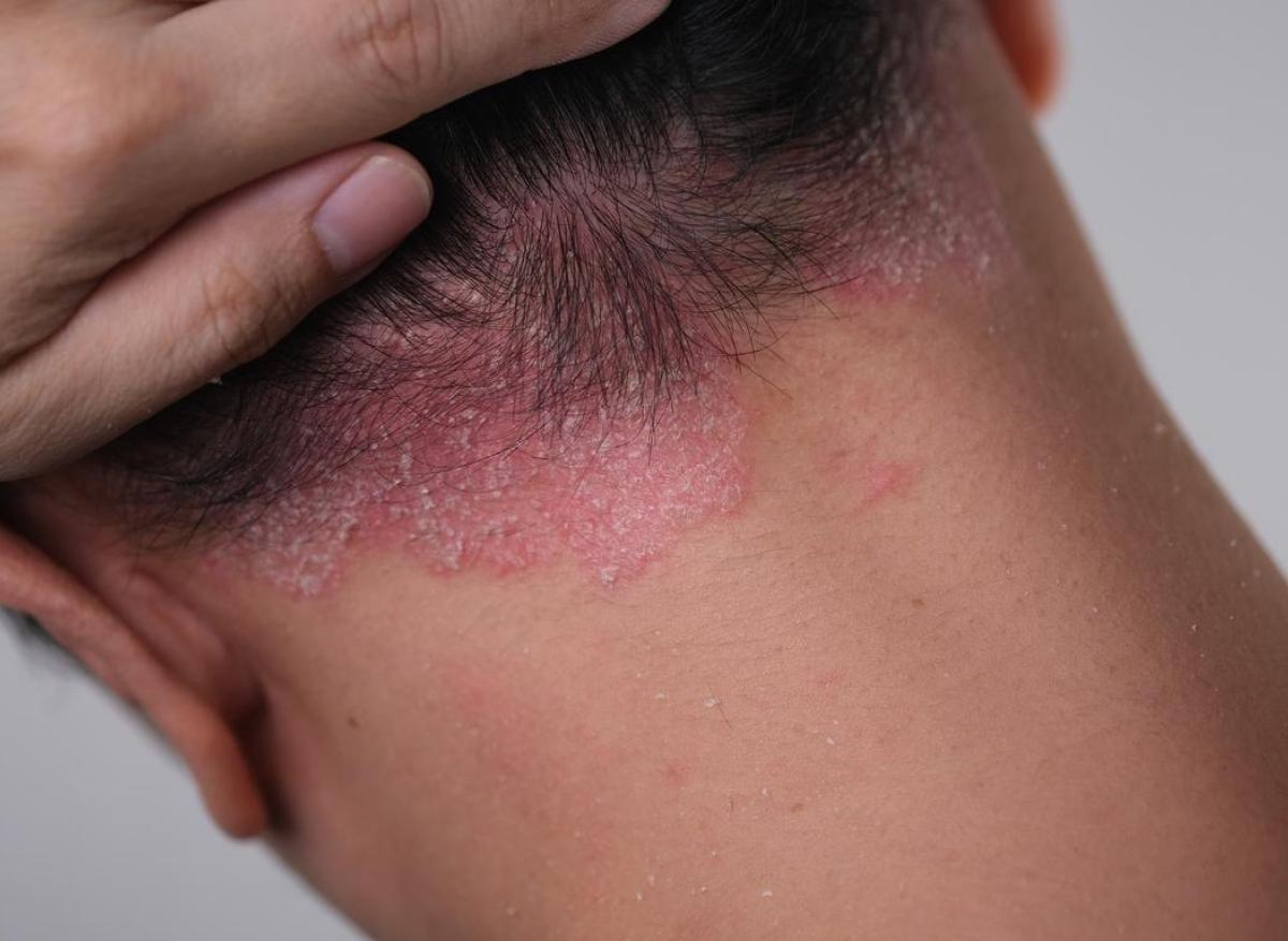 Une nouvelle cible dans le traitement du psoriasis