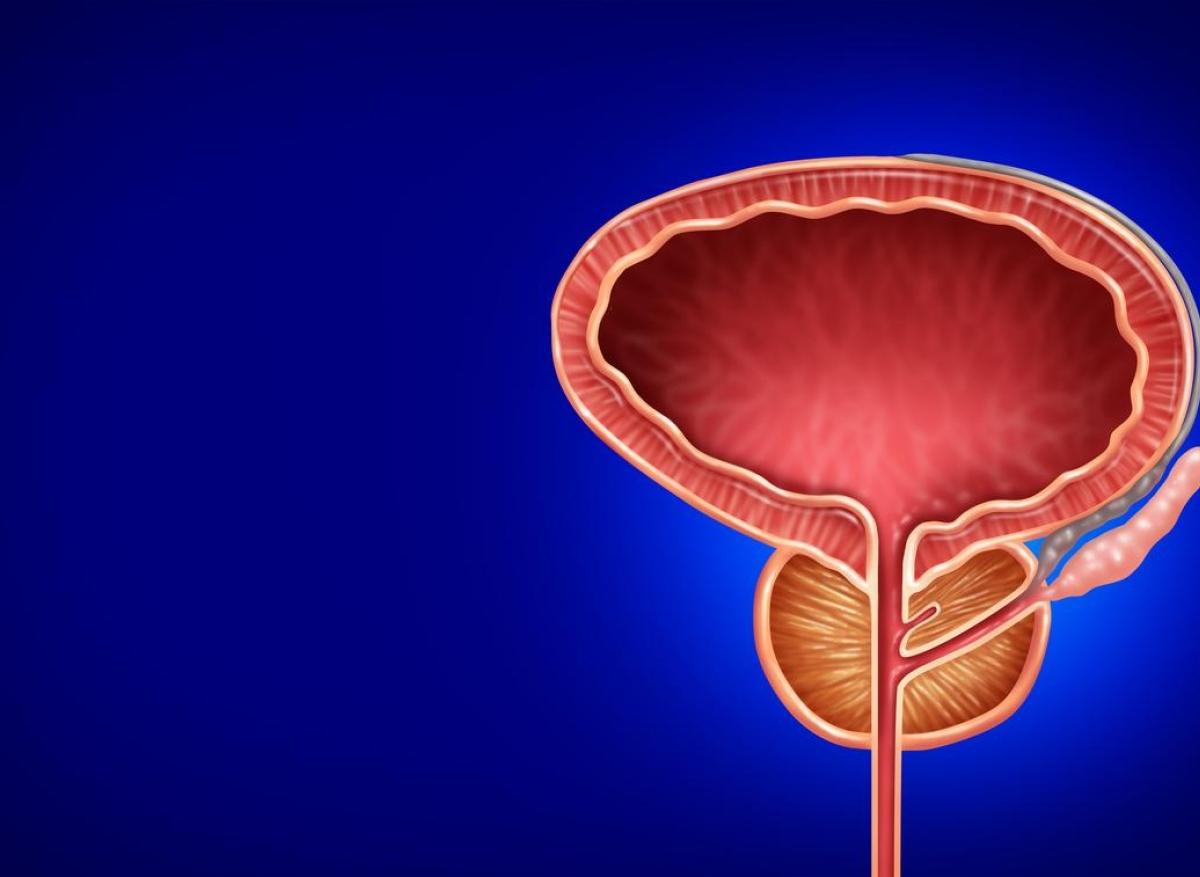 Cancer de la prostate : des dépistages à interpréter avec prudence chez les femmes transgenres