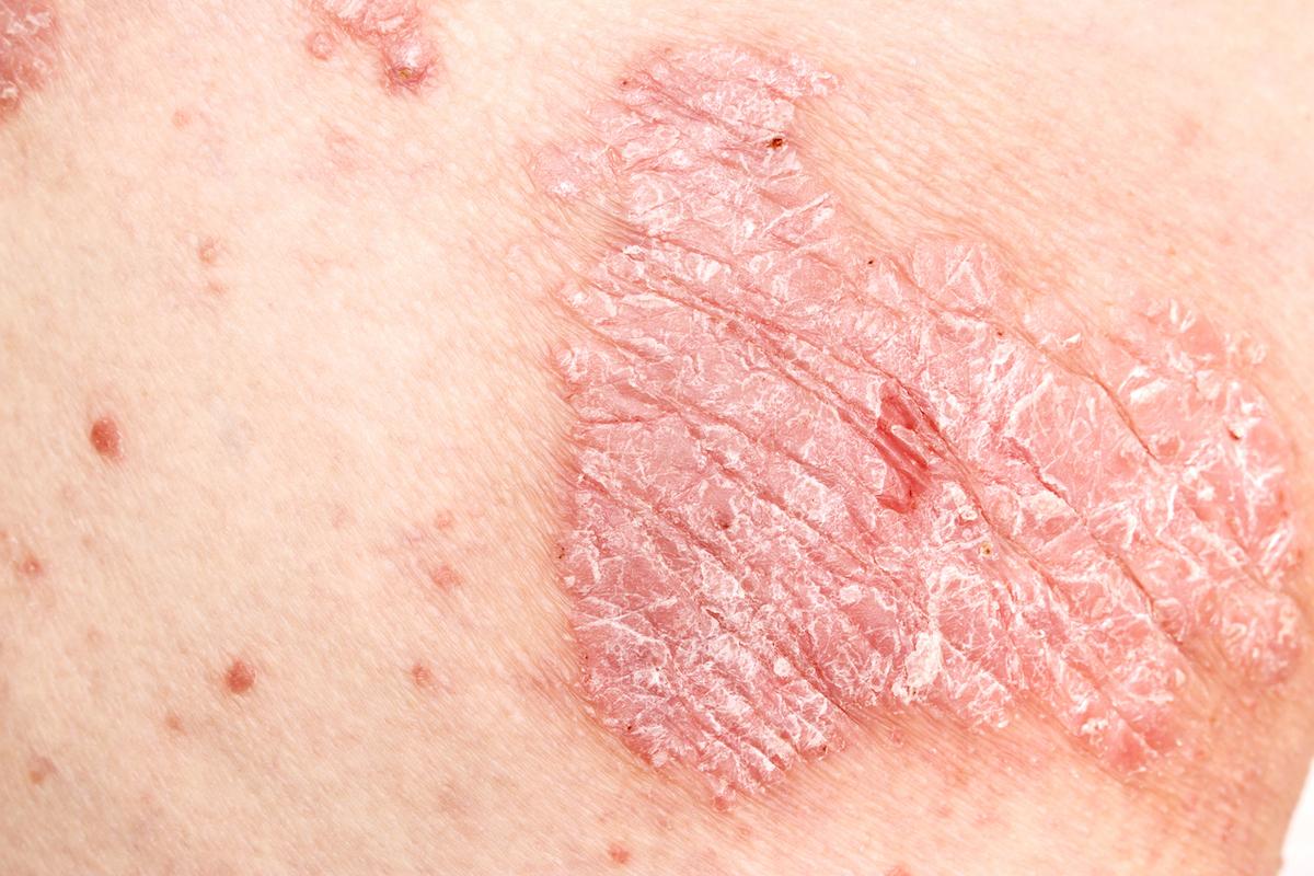 Psoriasis : au-delà de la peau, l’inflammation intestinale liée à l’immunité innée