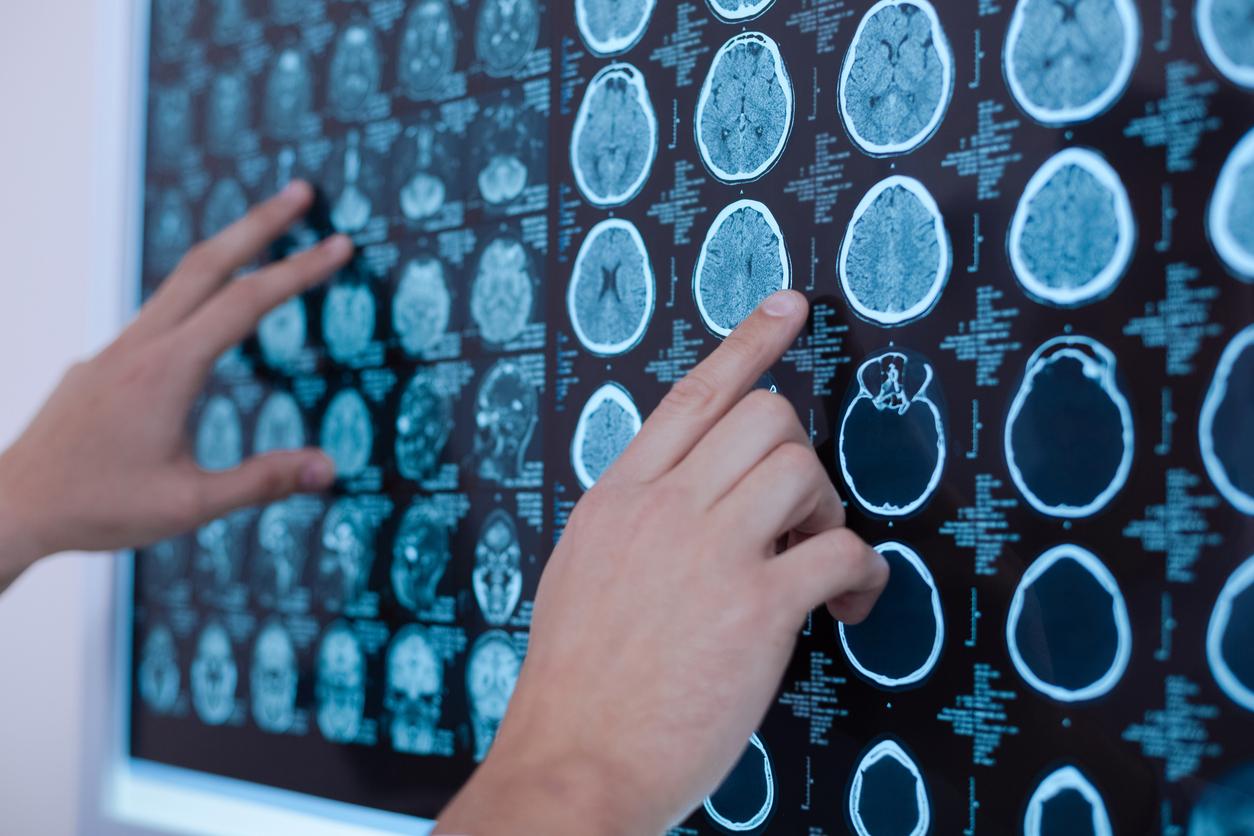 Un nouveau traitement contre le cancer du cerveau bientôt disponible aux États-Unis